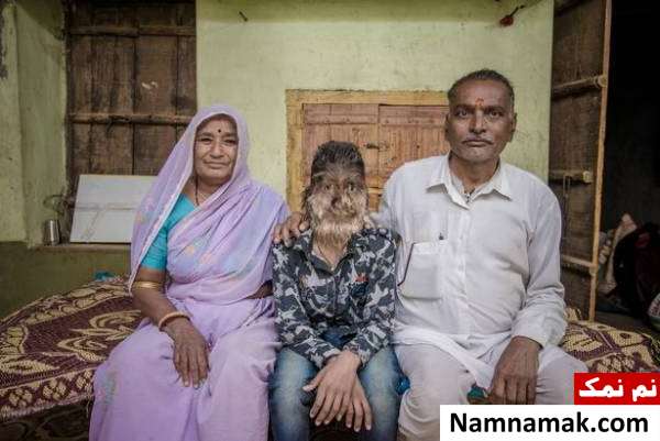 Werewolf syndrome