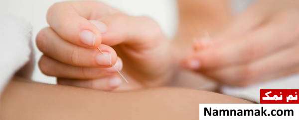 فواید لاغری با طب سوزنی کاهش وزن با طب سوزنی