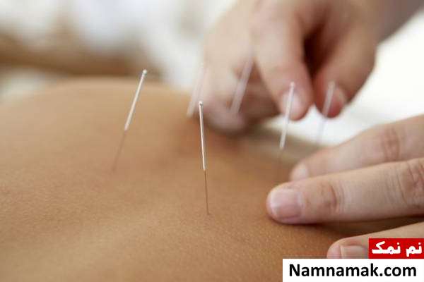 مضرات لاغری با طب سوزنی مزایای کاهش وزن با طب سوزنی