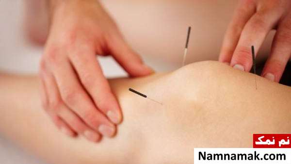 کم کردن سایز با طب سوزنی مزایای کاهش وزن با طب سوزنی