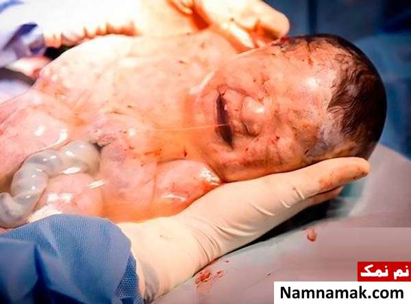 تولد نوزاد در داخل کیسه آمونیاک