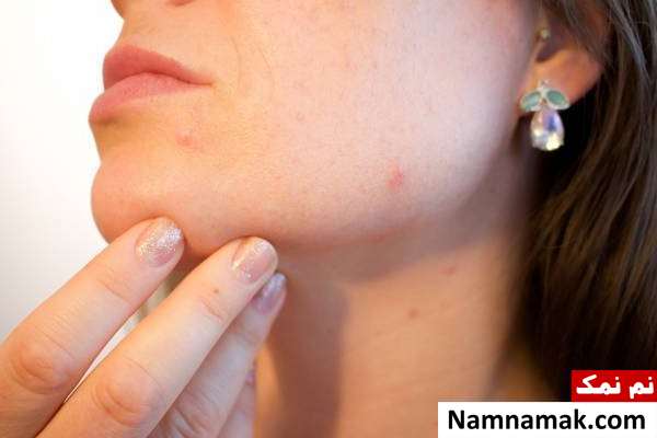 آفتاب برای جوش حمام آفتاب برای آکنه