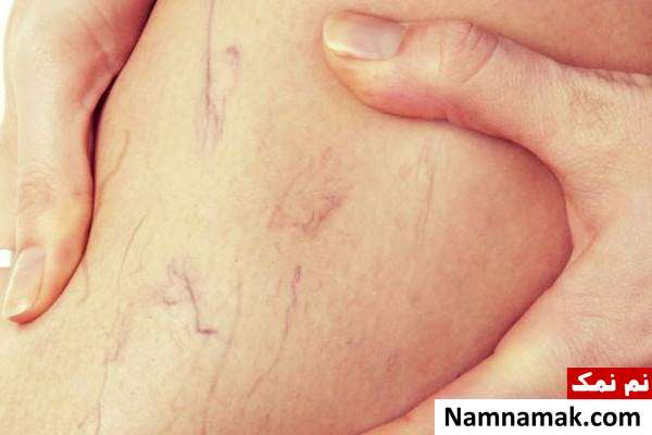 علت واریس دلیل اصلی واریس
