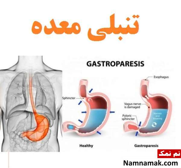 گاستروپارزی یا تنبلی معده چیست؟ گاستروپارزی یا تنبلی معده