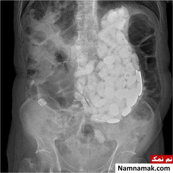 سنگ داخل شکم خارج کردن سنگ از شکم