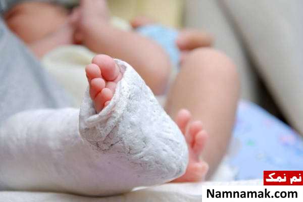 گچ گرفتن پای کودک درمان پای پرانتزی