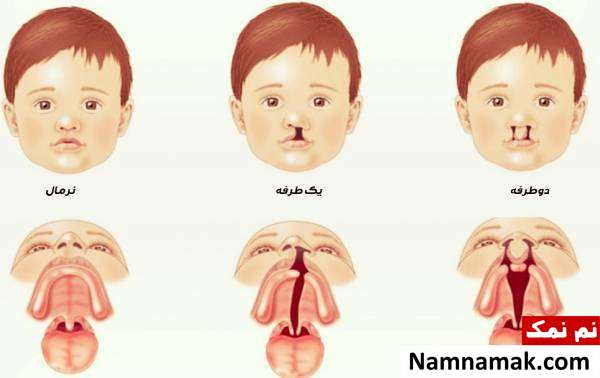 تشخیص لب شکری کودکان انواع لب شکری کودکان