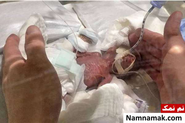 به دنیا آمدن ریز ترین نوزاد جهان 