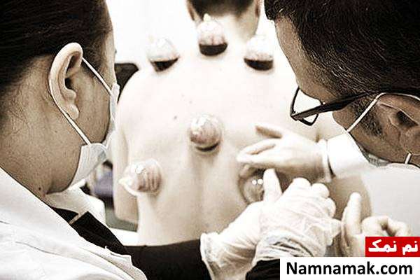 فواید حجامت بیماری های قابل درمان با حجامت