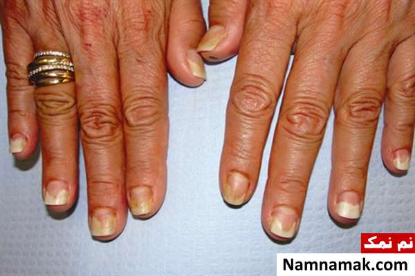 افتادن ناخن علت افتادن ناخن چیست؟