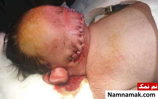 انسان متولد شده با دوسر به هم چسبیده