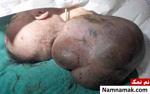 Encephalocele 