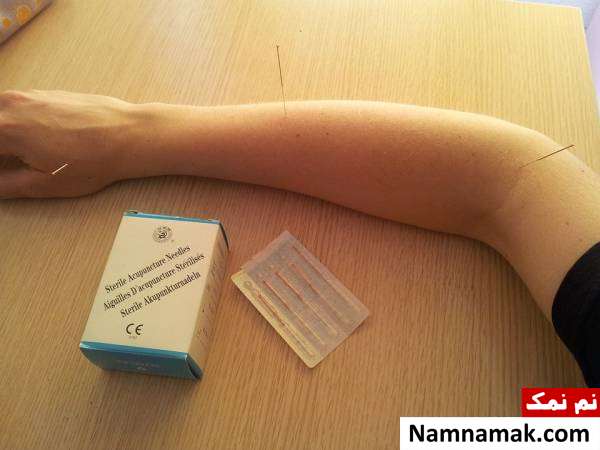 طب سوزنی برای لاغری شکم و پهلو