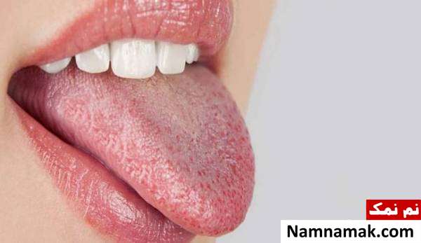 زبان خشک و سفید زبان خشک و سفید از علائم بوی بد دهان
