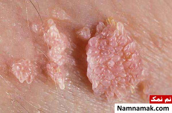 ویروس اچ پی وی (HPV) چگونه بفهمیم ویروس اچ پی وی (HPV) داریم؟