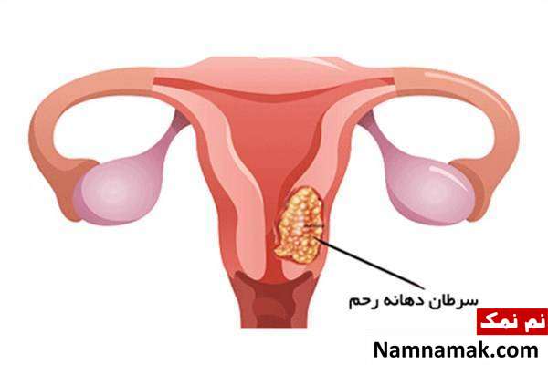 HPV اچ پی وی اچ پی وی چیست؟