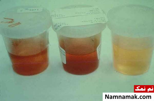 طریقه خواندن جواب آزمایش ادرار با تفسیر و جدول
