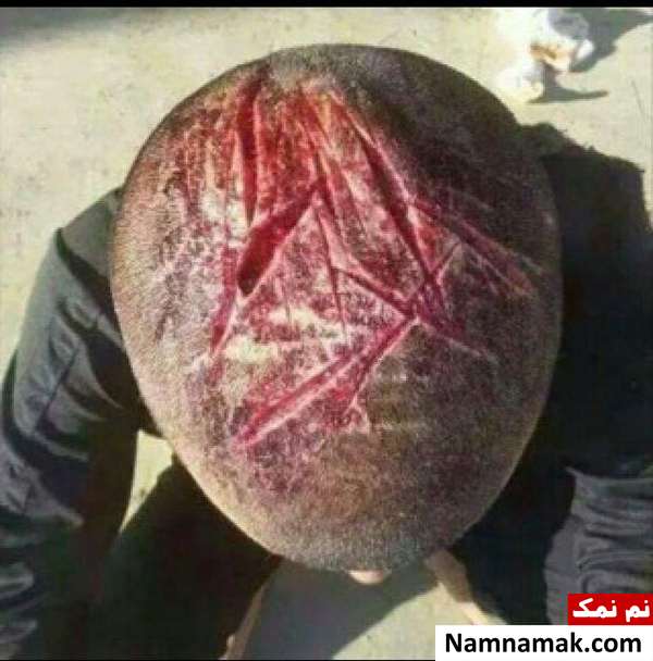 آثار خطرناک قمه زنی