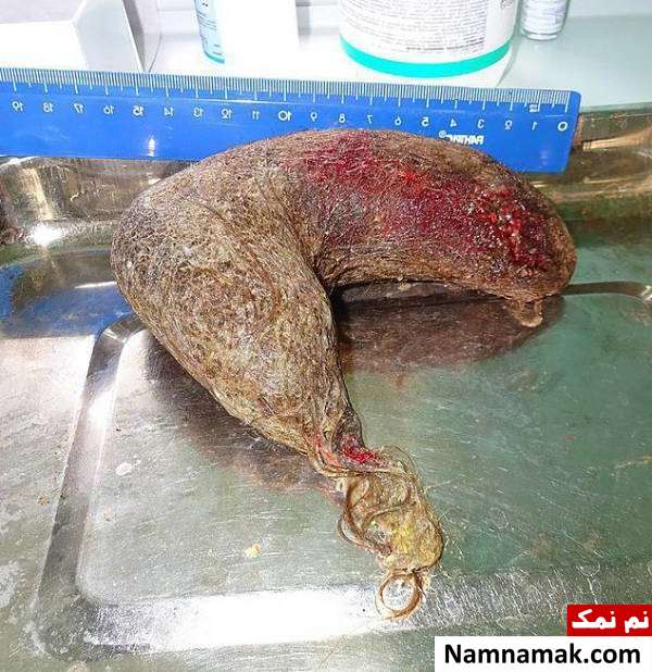 توده مویی غول مویی در شکم دختر نوجوان