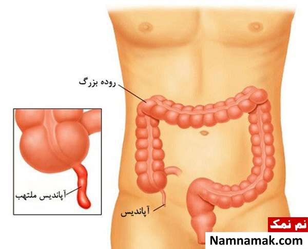 عوارض بعد از عمل اپاندیس چیست؟