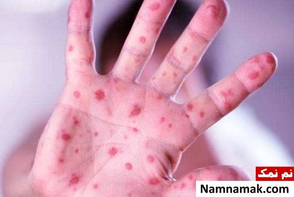سرخک در بارداری سرخک در جنین و کودکان