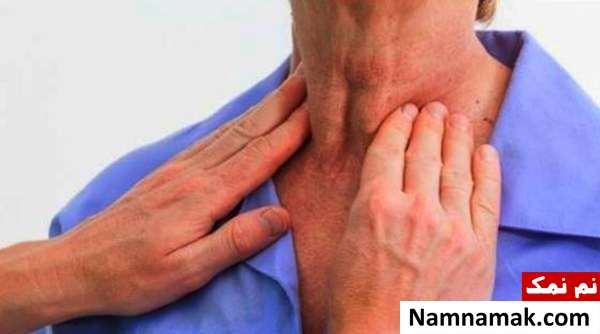 انواع سرطان تیروئید خطر ابتلا به سرطان تیروئید