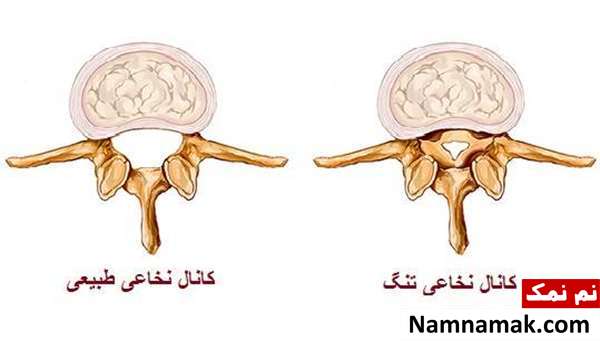 تشخیص تنگی کانال نخاعی