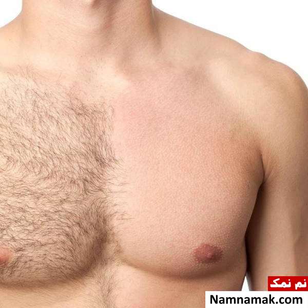 موهای زائد بدن