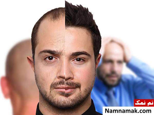 انواع روش های کاشت مو مقایسه انواع روش های کاشت مو