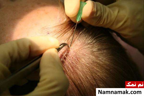 کاشت موی سر هزینه های روش های کاشت مو