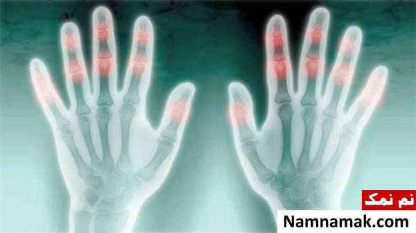 خطرات شکستن قولنج