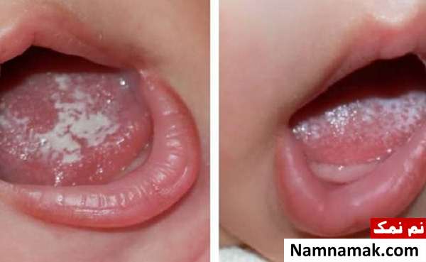 عکس و تصویری از شکل برفک دهان نوزاد