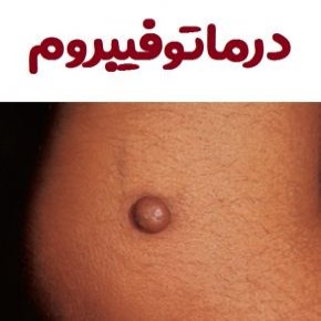 درماتوفیبروم
