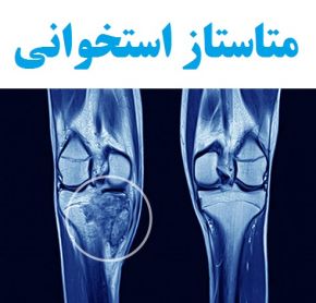 علل و علائم تومور یا متاستاز استخوانی + روش های درمان