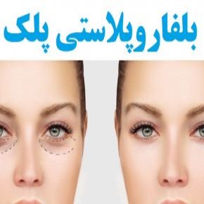 بلفاروپلاستی پلک