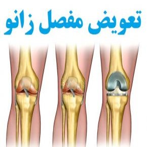 تعویض مفصل زانو