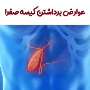 عوارض برداشتن کیسه صفرا