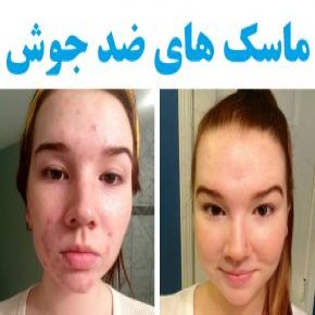 ماسک های ضد جوش و آکنه برای انواع پوست