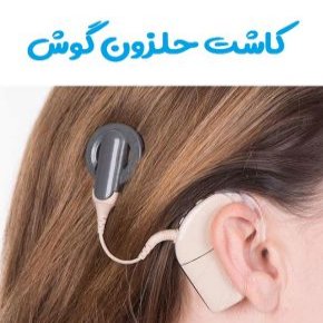 کاشت حلزون گوش