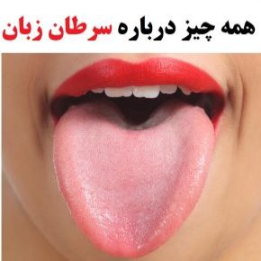 سرطان زبان
