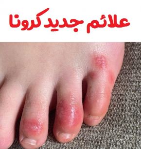 علائم جدید کرونا و ابتلا به ویروس کووید 19
