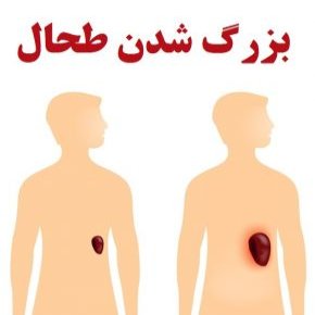علائم بزرگ شدن طحال و علل و درمان خانگی طحال بزرگ شده