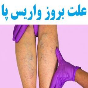 علت بروز واریس پا