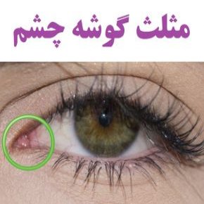 مثلث گوشه چشم