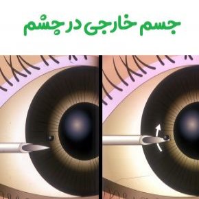 علائم وجود جسم خارجی در چشم + روش خارج کردن