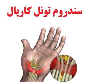 سندروم تونل کارپال دست و علل ، علائم و نحوه درمان آن