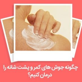 علت جوش پشت کمر و درمان گیاهی آن در طب سنتی