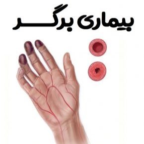 بیماری برگر