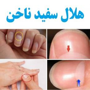تشخیص بیماریها با هلال سفید پایین ناخن ، لونولا یا ماهک ناخن