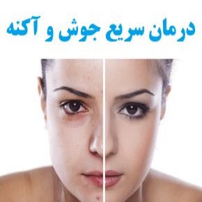 علت جوش و آکنه و درمان سریع آن با 36 روش خانگی